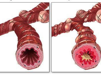 dpoc-fisioterapia-avancada-porto